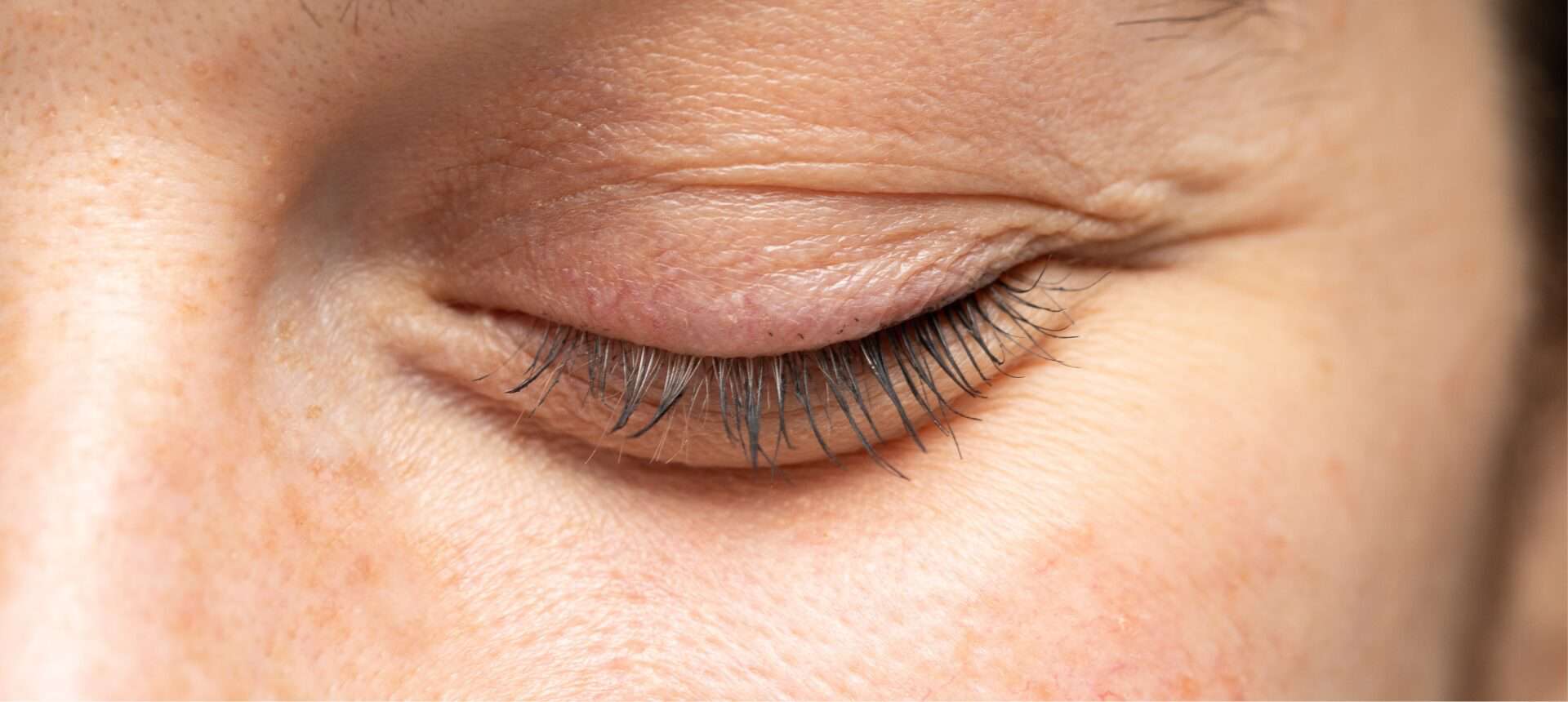 Closed eye showing eyelid relating to Oculoplastics (eyelid surgery) at Sapphire Eye Care