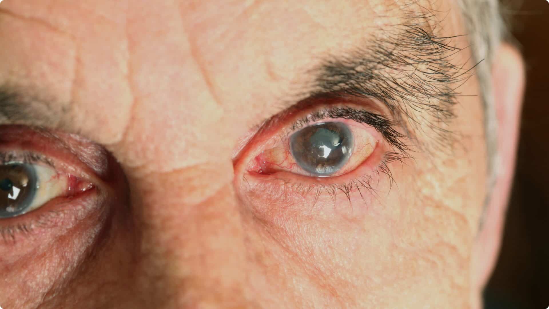 Elderly eyes and irises relating to Vitreous Haemorrhage at Sapphire Eye Care