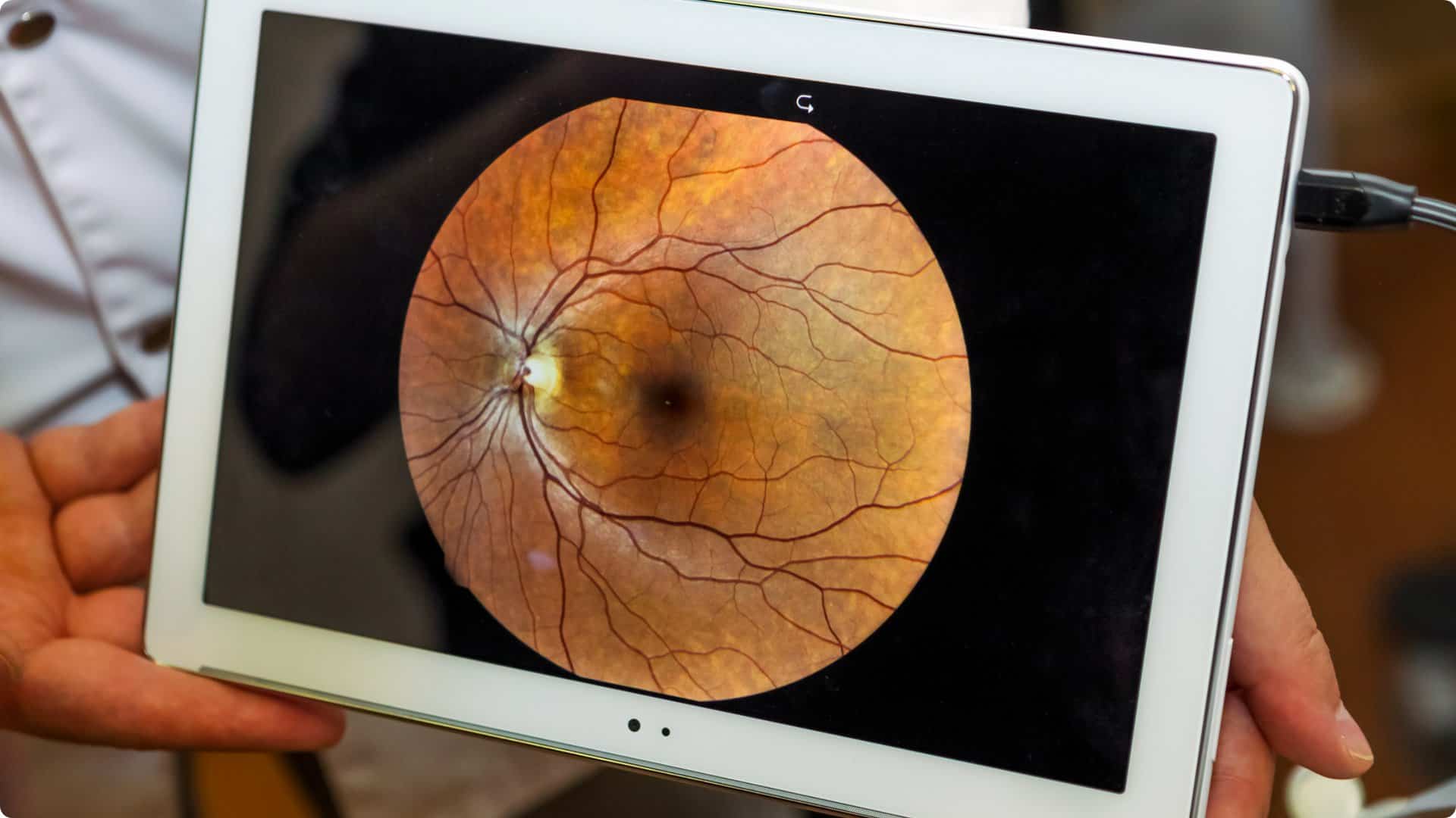 iPad image of the internal of an eye relating to macular degeneration at Sapphire Eye Care