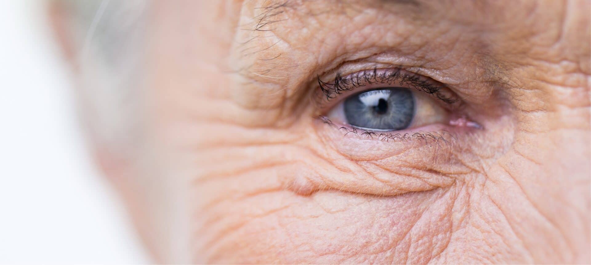 Cataracts Sapphire Eye Care